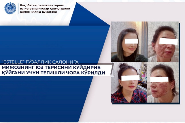 Beauty salon Estelle in Tashkent accused of causing severe chemical burn to client
